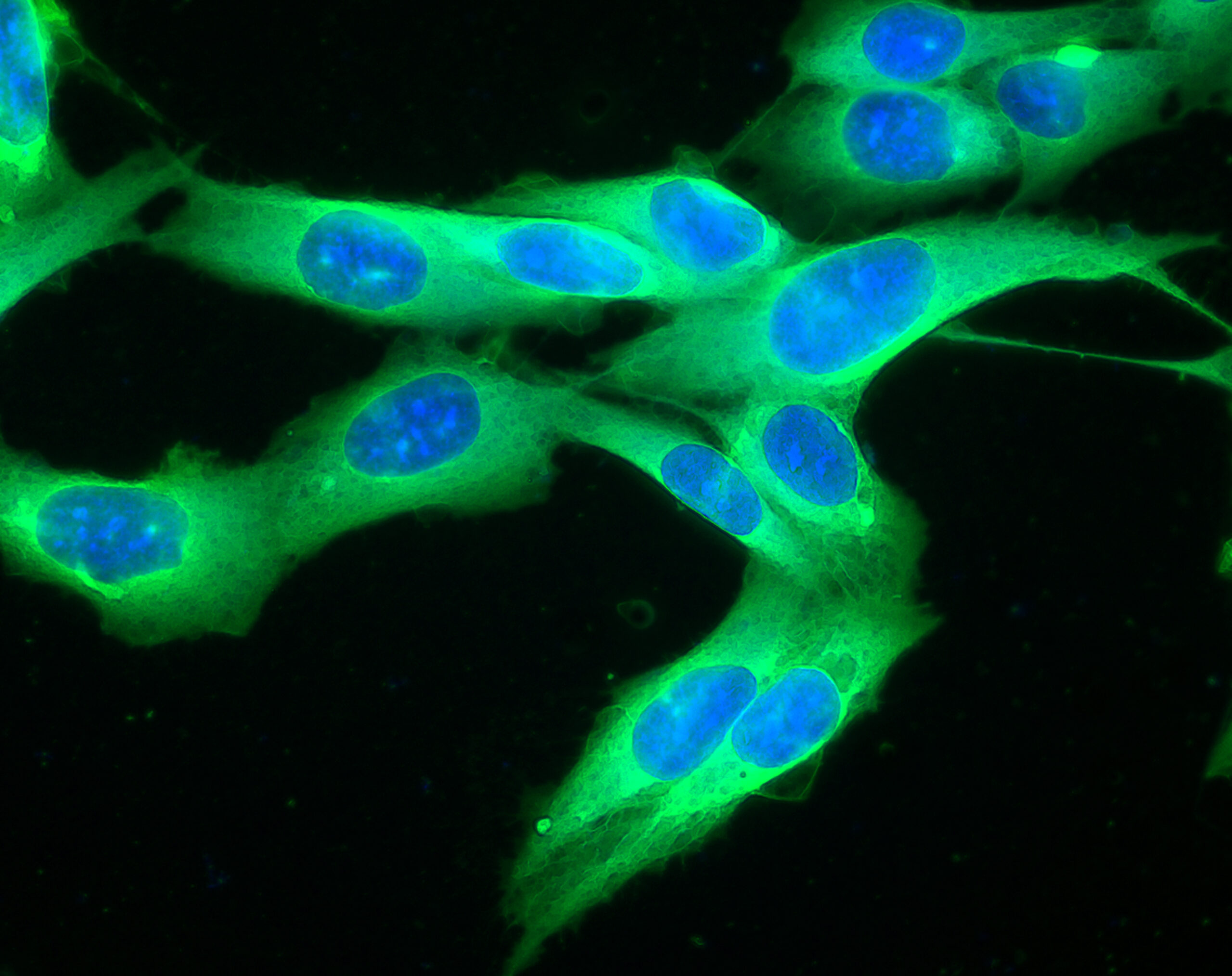 Picture of a human melanoma cell line growing in tissue culture. The study of cancer cell lines such as this one allows scientists to investigate the cancer cell biological processes and ways to modify them in order to design and test new treatments.